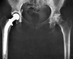 How to Prevent Hip Osteoarthritis and Avoid Hip Replacement Surgery